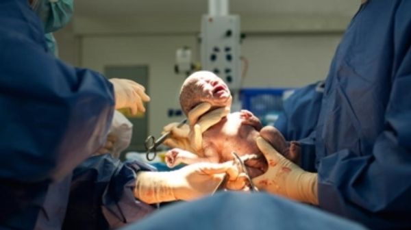 C-Section